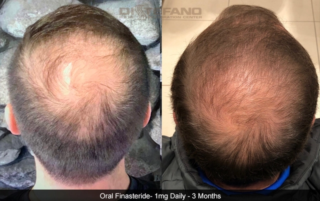 The Pros and Cons of Using Finasteride for Hair Loss Treatment